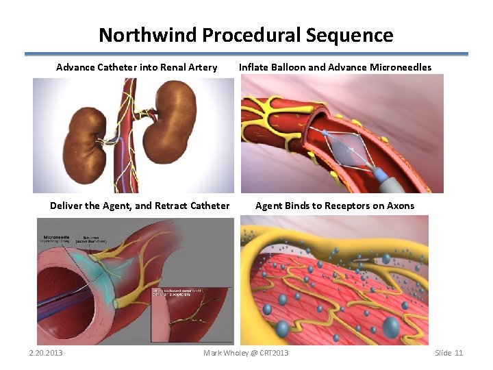 Northwind Procedural Sequence Advance Catheter into Renal Artery Inflate Balloon and Advance Microneedles Deliver