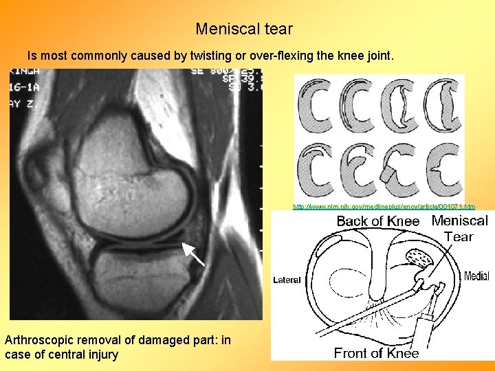 Meniscal tear Is most commonly caused by twisting or over-flexing the knee joint. http: