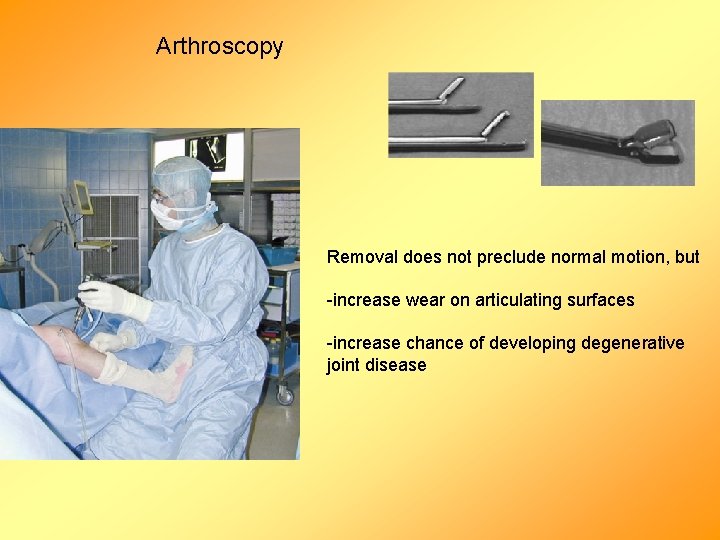 Arthroscopy Removal does not preclude normal motion, but -increase wear on articulating surfaces -increase