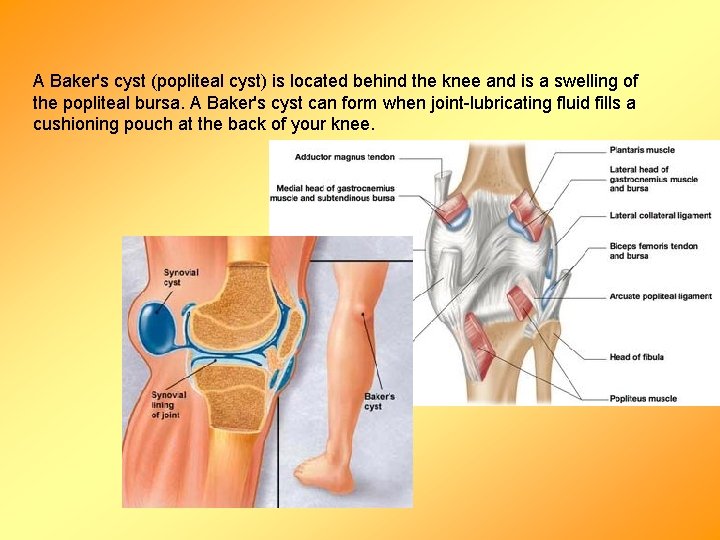 A Baker's cyst (popliteal cyst) is located behind the knee and is a swelling