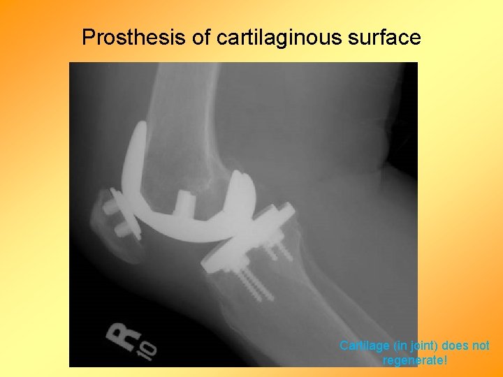 Prosthesis of cartilaginous surface Cartilage (in joint) does not regenerate! 