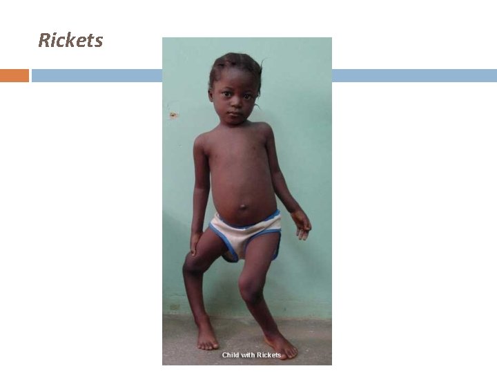 Rickets 