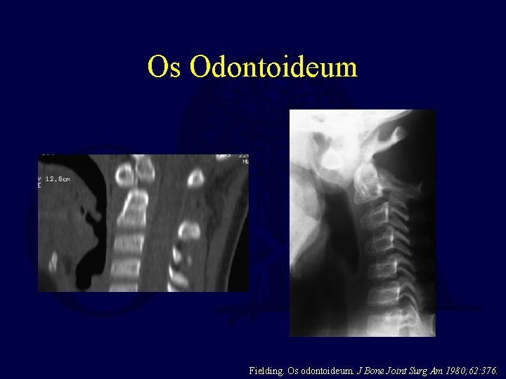 Os Odontoideum Fielding. Os odontoideum. J Bone Joint Surg Am 1980; 62: 376. 