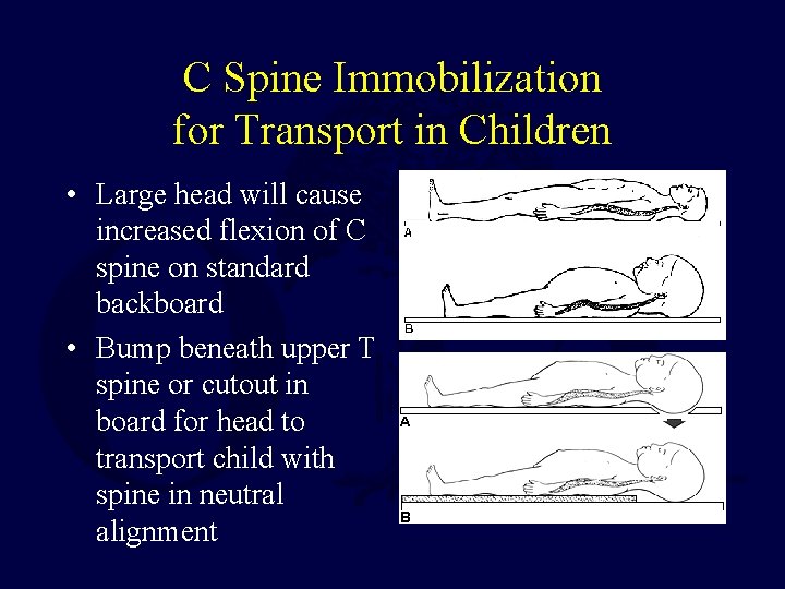 C Spine Immobilization for Transport in Children • Large head will cause increased flexion