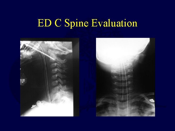 ED C Spine Evaluation 