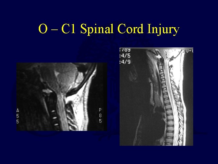 O – C 1 Spinal Cord Injury 