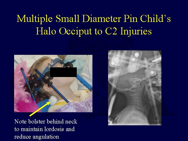 Multiple Small Diameter Pin Child’s Halo Occiput to C 2 Injuries Note bolster behind