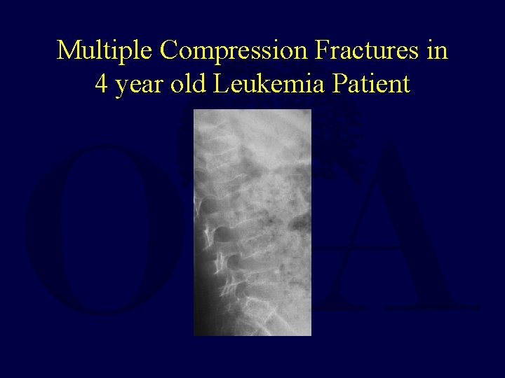 Multiple Compression Fractures in 4 year old Leukemia Patient 