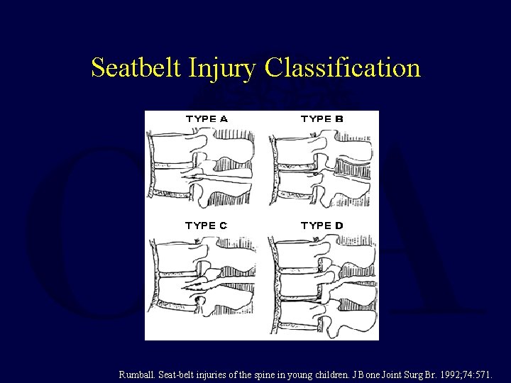 Seatbelt Injury Classification Rumball. Seat-belt injuries of the spine in young children. J Bone
