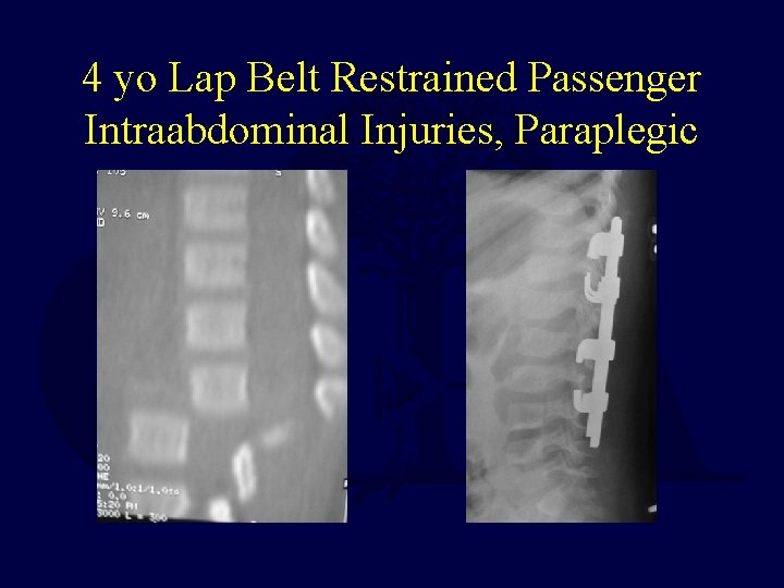 4 yo Lap Belt Restrained Passenger Intraabdominal Injuries, Paraplegic 