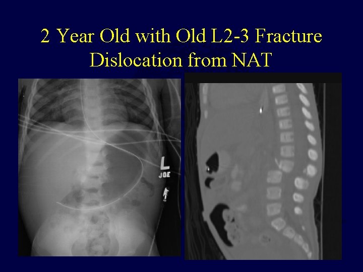 2 Year Old with Old L 2 -3 Fracture Dislocation from NAT 