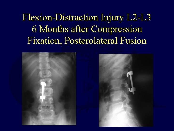 Flexion-Distraction Injury L 2 -L 3 6 Months after Compression Fixation, Posterolateral Fusion 