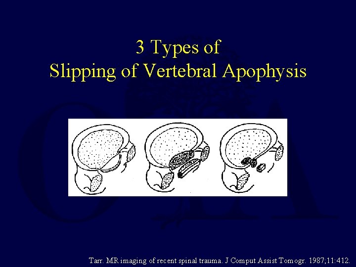 3 Types of Slipping of Vertebral Apophysis Tarr. MR imaging of recent spinal trauma.