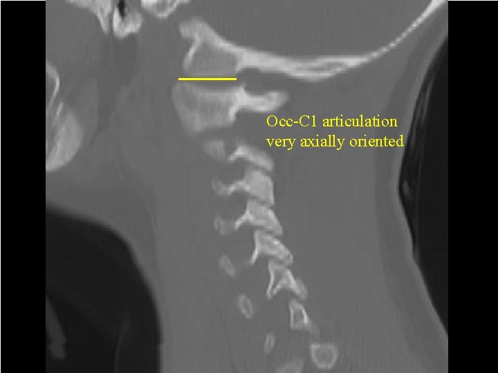 Multiple Small Diameter Pin Child’s Halo for Displaced C 2 Fracture Occ-C 1 articulation