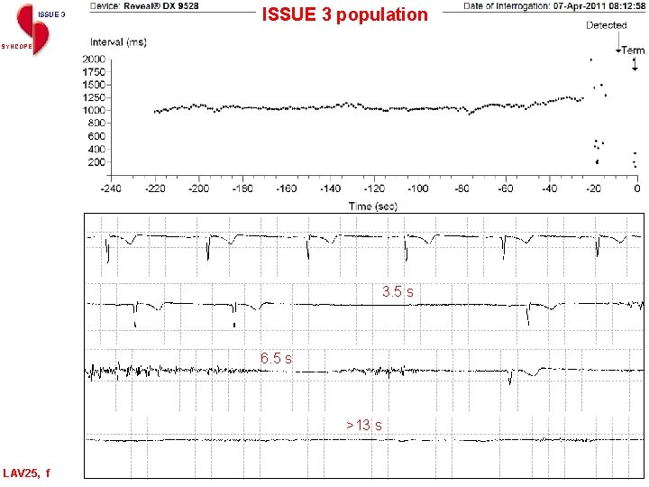 ISSUE 3 population SYNCOPE 3. 5 s 6. 5 s >13 s LAV 25,