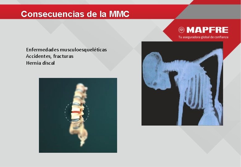 Consecuencias de la MMC Enfermedades musculoesqueléticas Accidentes, fracturas Hernia discal 