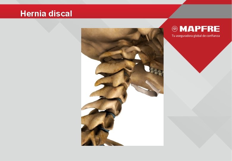Hernia discal 