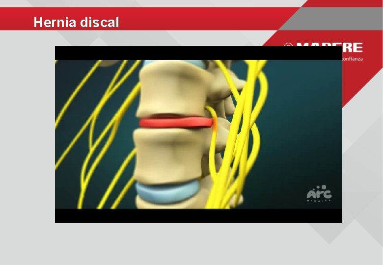 Hernia discal 