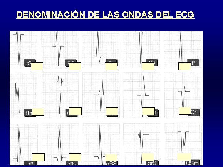 DENOMINACIÓN DE LAS ONDAS DEL ECG 