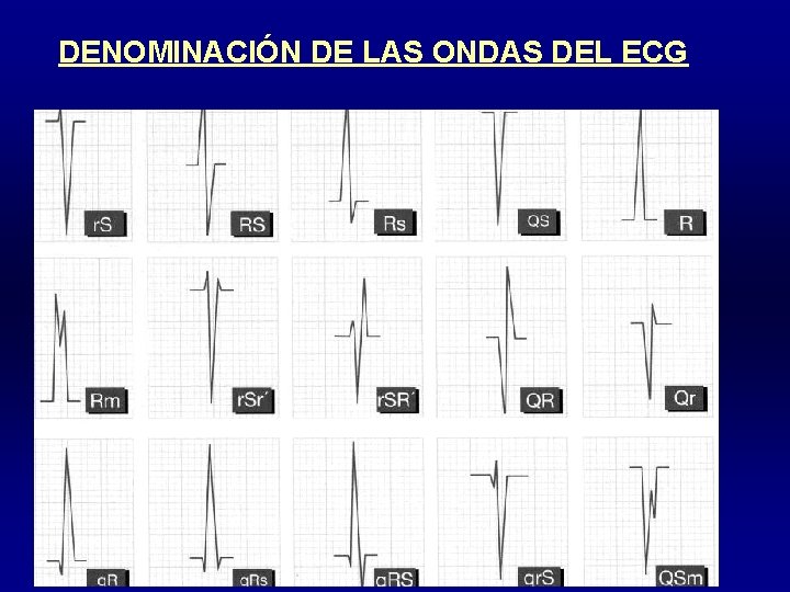 DENOMINACIÓN DE LAS ONDAS DEL ECG 