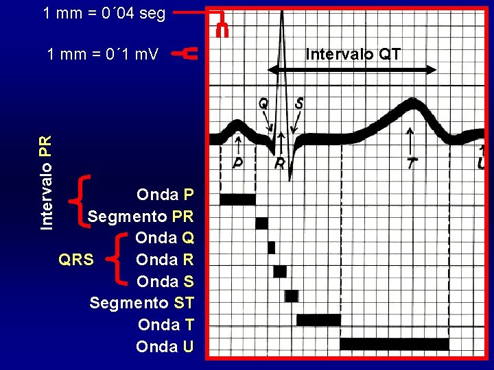 1 mm = 0´ 04 seg Intervalo PR 1 mm = 0´ 1 m.