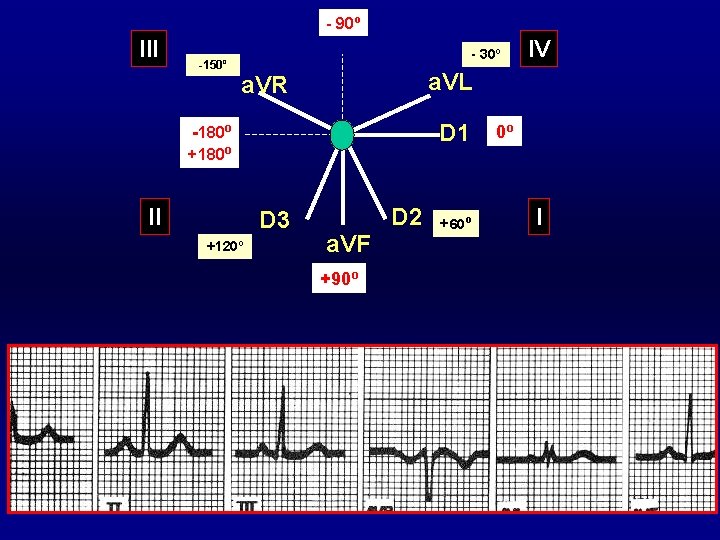 - 90º III -150º - 30º a. VL a. VR D 1 -180º +180º