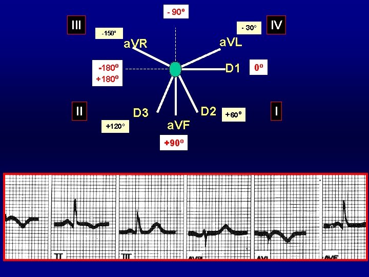 - 90º III -150º - 30º a. VL a. VR D 1 -180º +180º