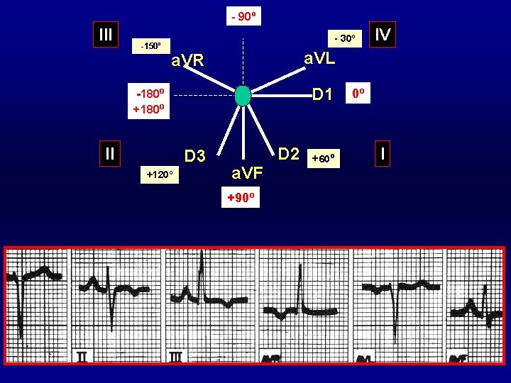 - 90º III -150º - 30º a. VL a. VR D 1 -180º +180º