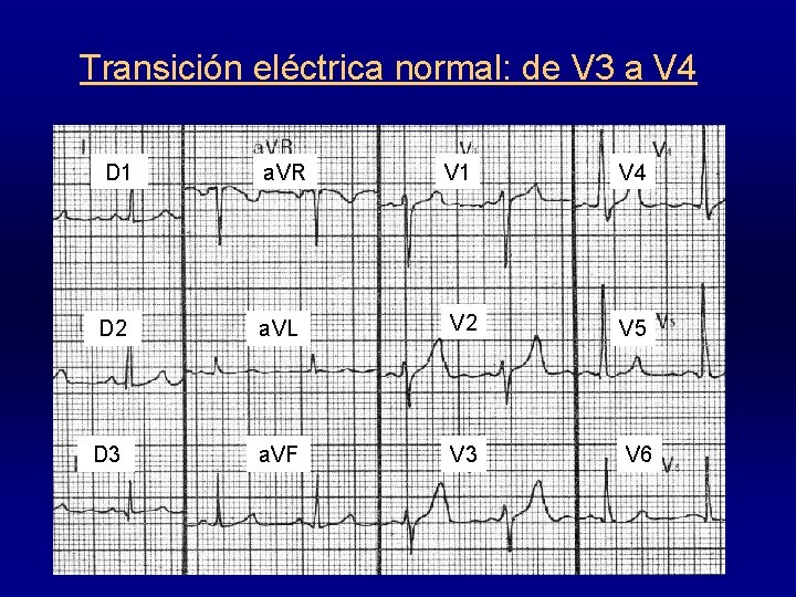 Transición eléctrica normal: de V 3 a V 4 D 1 a. VR V