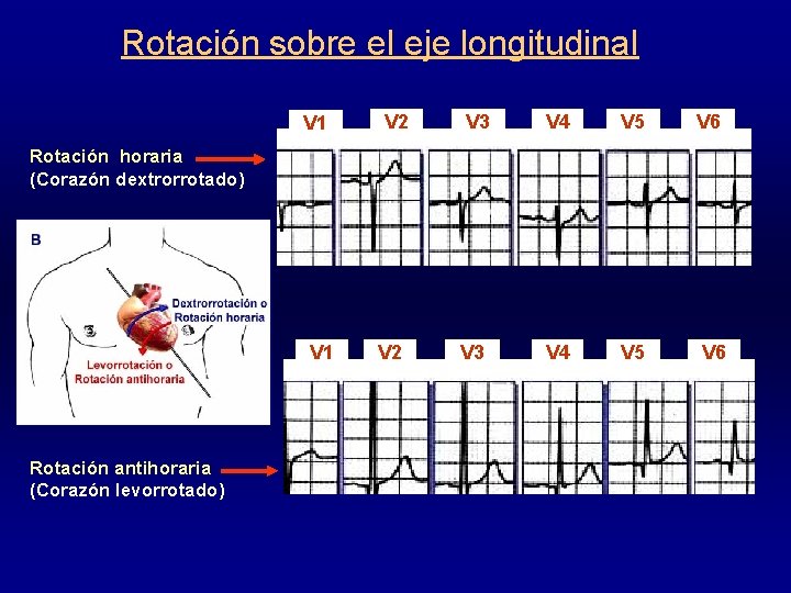 Rotación sobre el eje longitudinal V 1 V 2 V 3 V 4 V