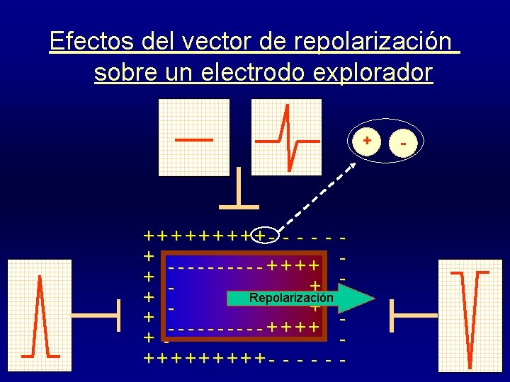 Efectos del vector de repolarización sobre un electrodo explorador + +++++- - + -----++++