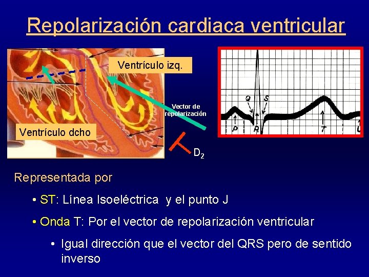 Repolarización cardiaca ventricular Ventrículo izq. Vector de repolarización Ventrículo dcho D 2 Representada por