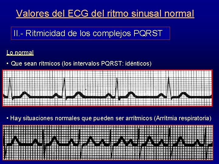 Valores del ECG del ritmo sinusal normal II. - Ritmicidad de los complejos PQRST