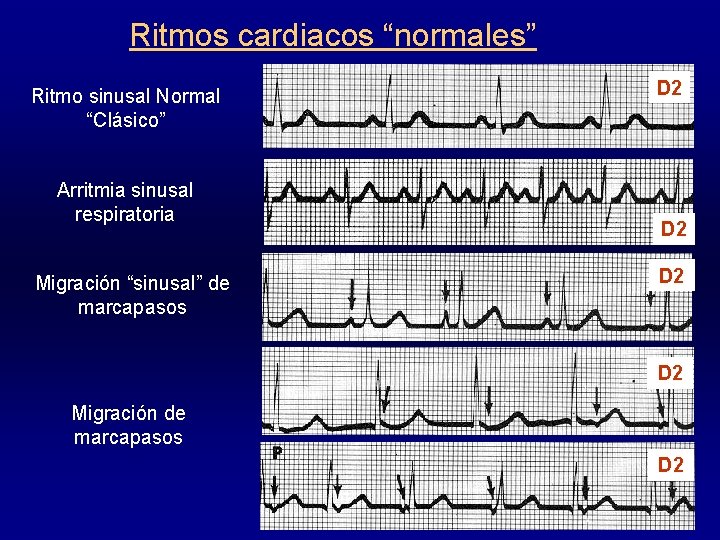 Ritmos cardiacos “normales” Ritmo sinusal Normal “Clásico” Arritmia sinusal respiratoria Migración “sinusal” de marcapasos