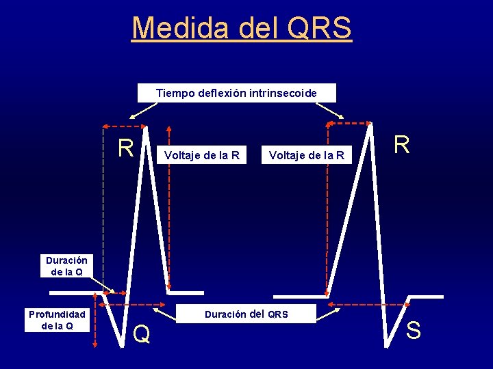 Medida del QRS Tiempo deflexión intrinsecoide R Voltaje de la R R Duración de