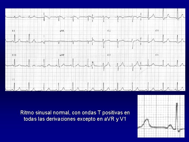 Ritmo sinusal normal, con ondas T positivas en todas las derivaciones excepto en a.