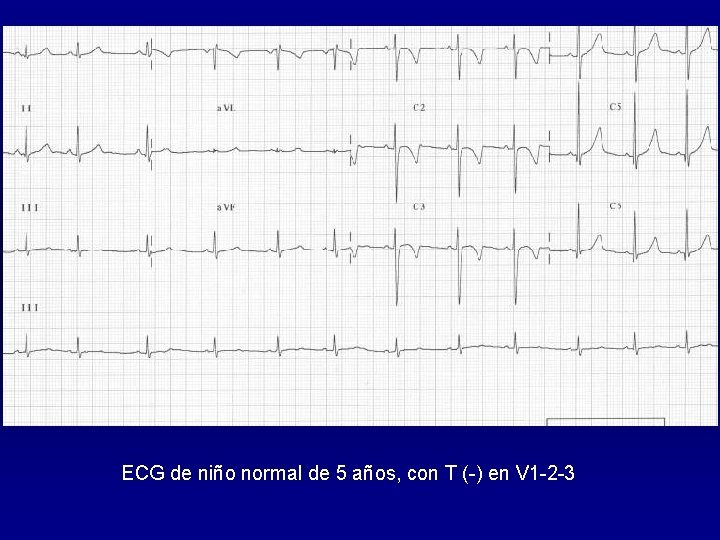 ECG de niño normal de 5 años, con T (-) en V 1 -2