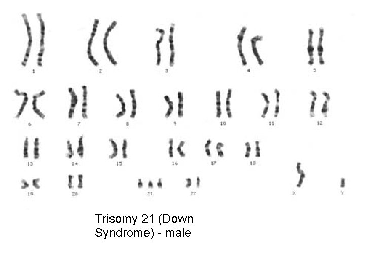 Trisomy 21 (Down Syndrome) - male 