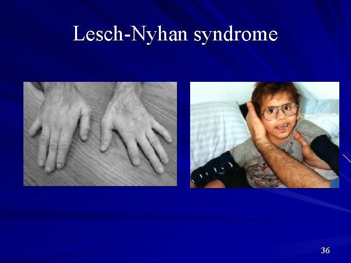 Lesch-Nyhan syndrome 36 