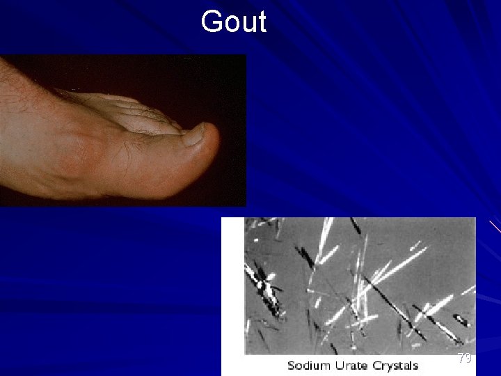 Gout 79 