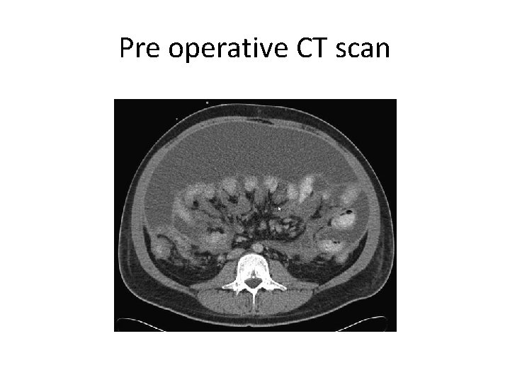 Pre operative CT scan 