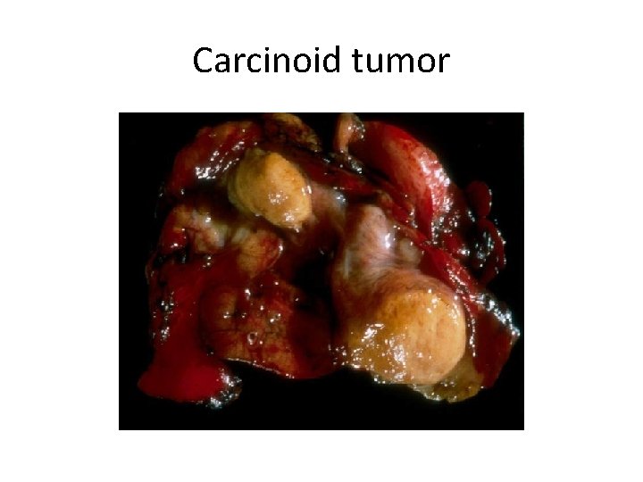 Carcinoid tumor 