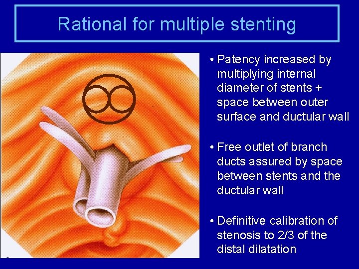 Rational for multiple stenting • Patency increased by multiplying internal diameter of stents +