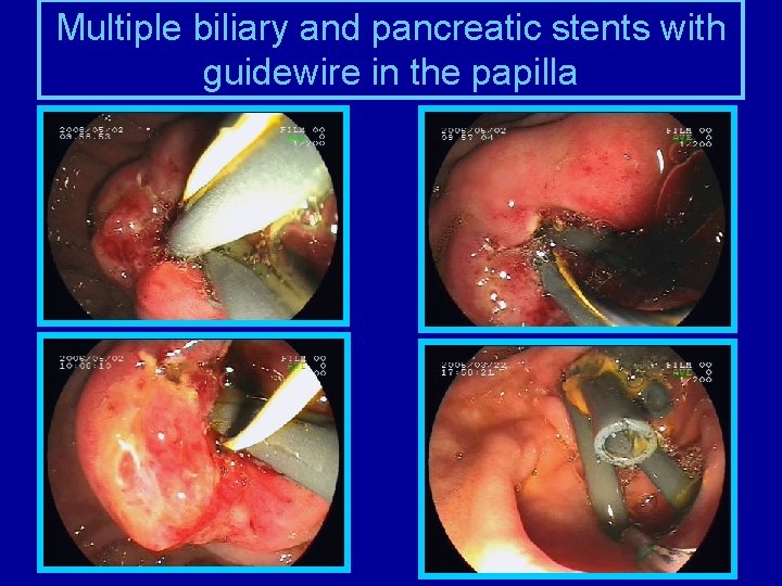 Multiple biliary and pancreatic stents with guidewire in the papilla 