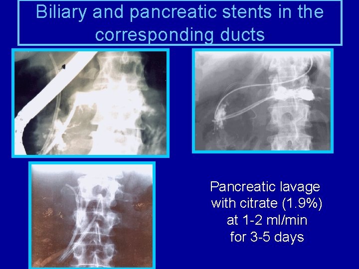 Biliary and pancreatic stents in the corresponding ducts Pancreatic lavage with citrate (1. 9%)