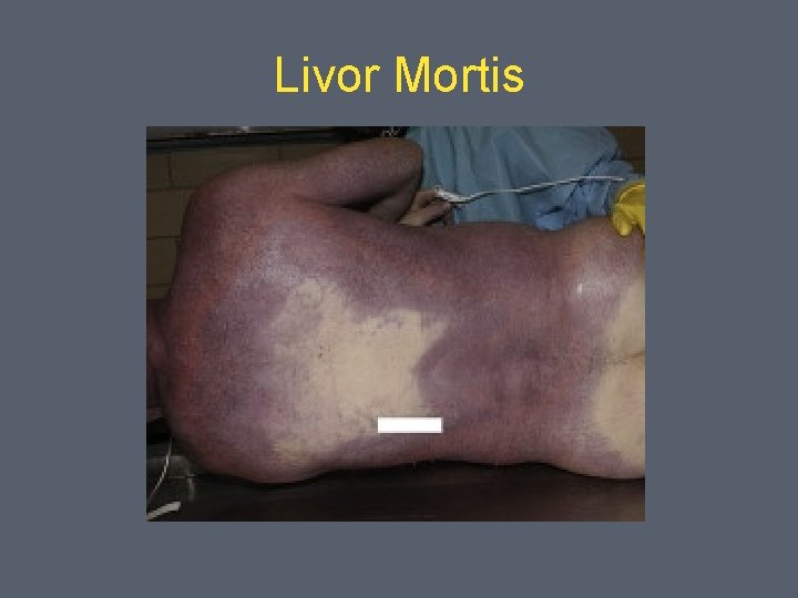 Livor Mortis 