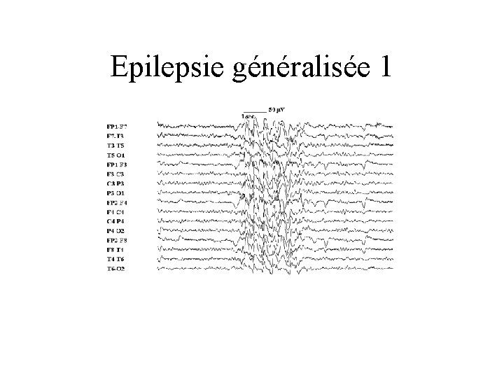 Epilepsie généralisée 1 