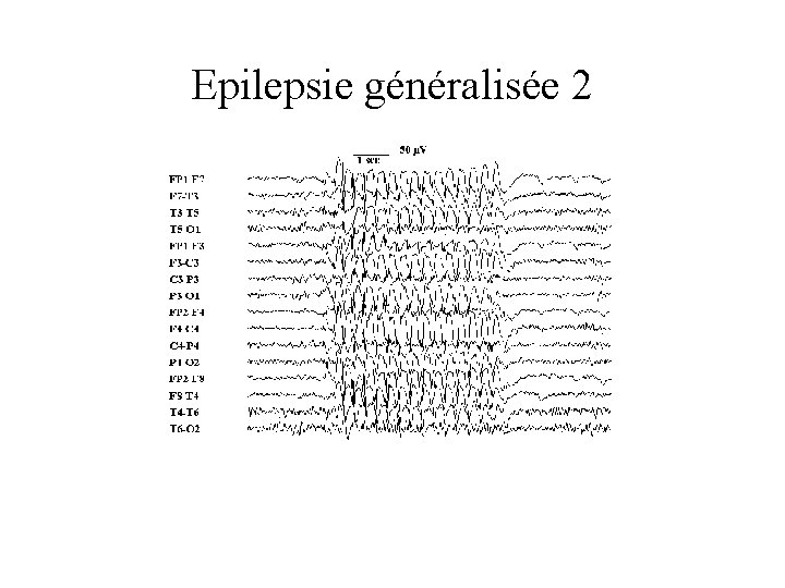 Epilepsie généralisée 2 