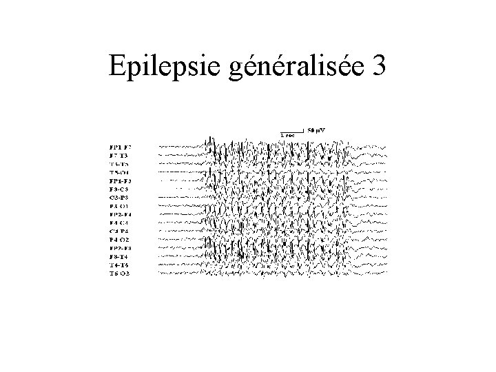 Epilepsie généralisée 3 