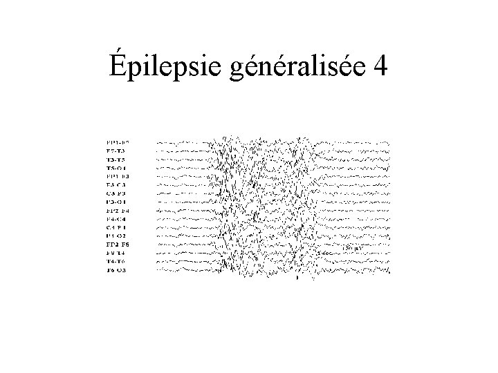 Épilepsie généralisée 4 